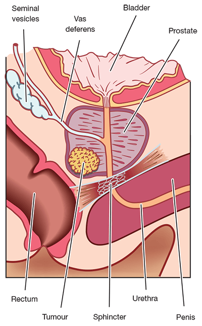 Understanding Urinary Problems | PCFA Understanding Urinary Problems | PCFA