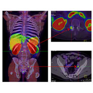 New PET/CT scans may guide treatment for prostate cancer