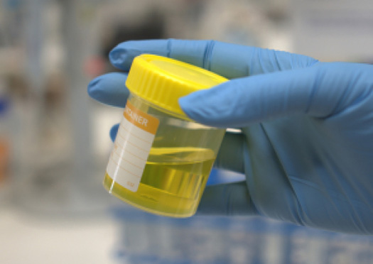 A promising new urine test for prostate cancer is being developed