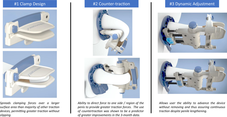 Penile traction therapy PCFA PCFA